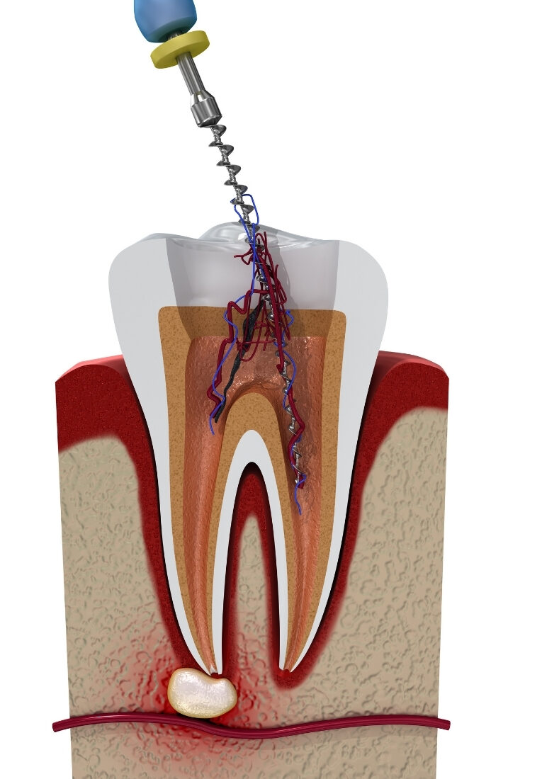 歯の神経(歯髄)と根管治療のイメージ