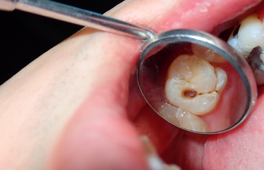 虫歯チェックのイメージ