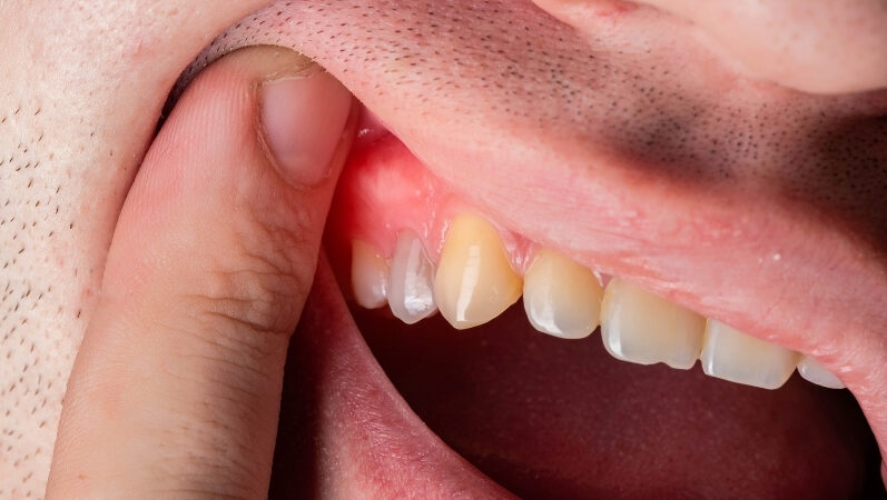 歯ぐきの腫れの原因イメージ