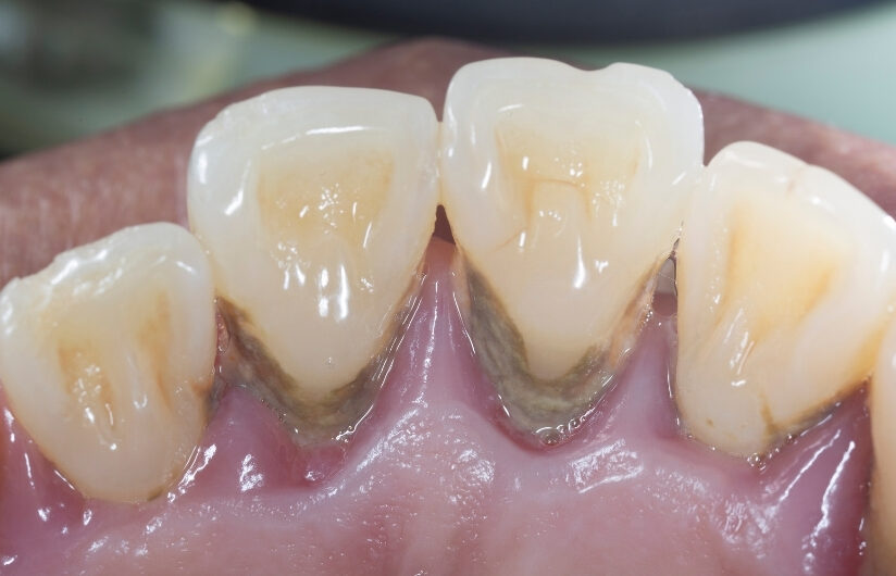 歯石のイメージ図