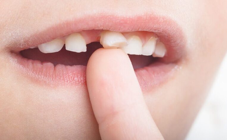 歯の生え変わりイメージ