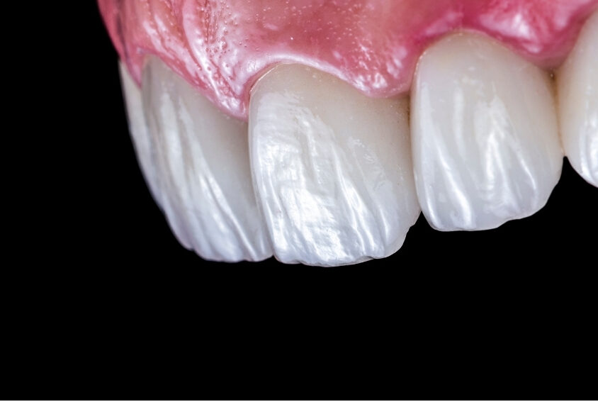 銀歯とセラミックの比較イメージ