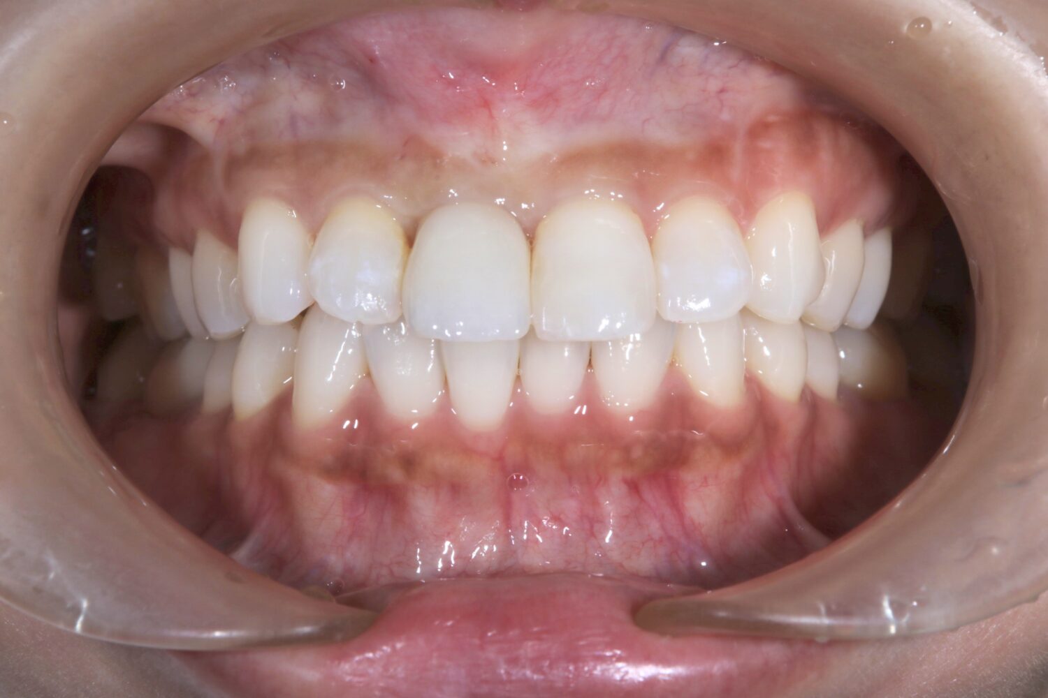 インプラント治療後の最終補綴物