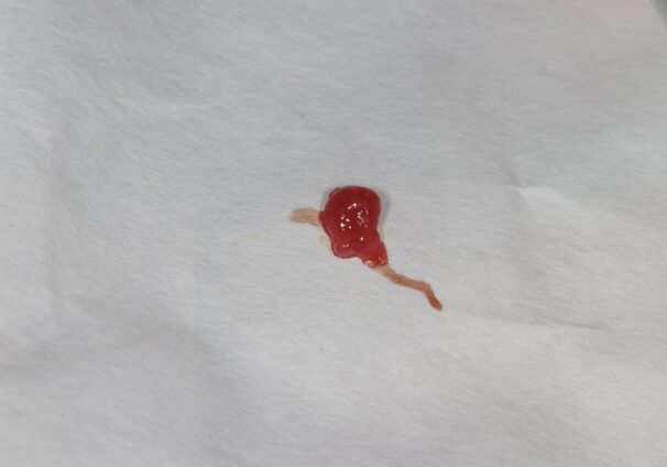 嚢胞摘出時の写真