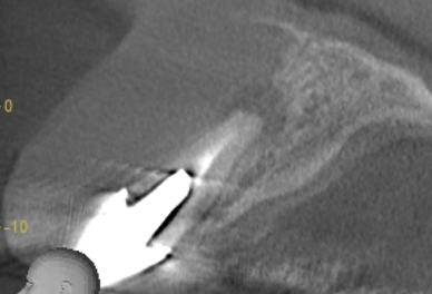 レントゲン写真