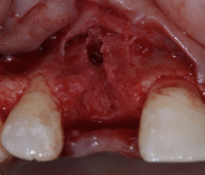 インプラント埋入時の骨の状態