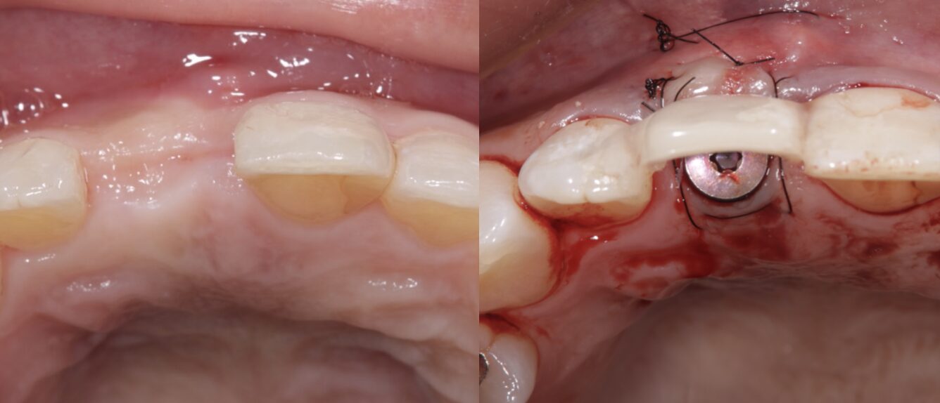 結合組織移植術の治療前後の写真