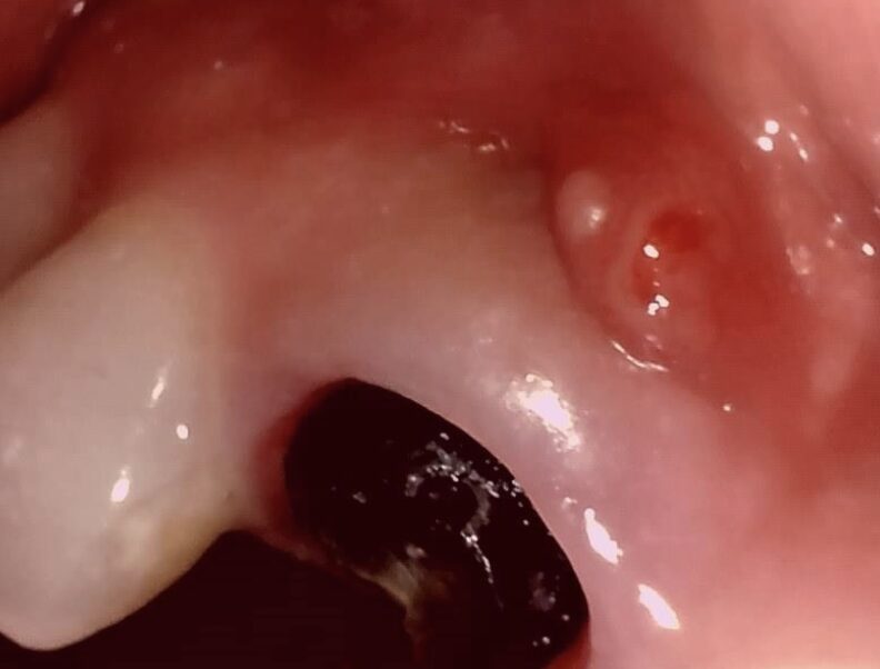 初診時の前歯の状態2