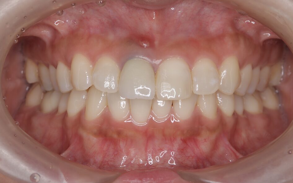 初診時の前歯の状態1