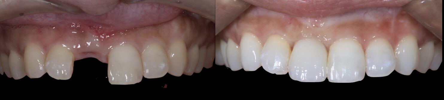 術前後の比較写真