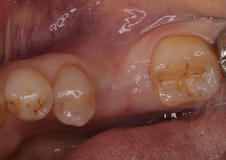 インプラント治療前
