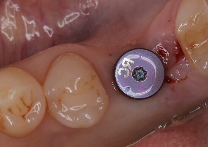 インプラント埋入直後