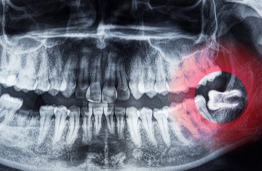 親知らずのイメージ