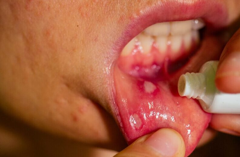 口内炎の原因と歯科での対策イメージ