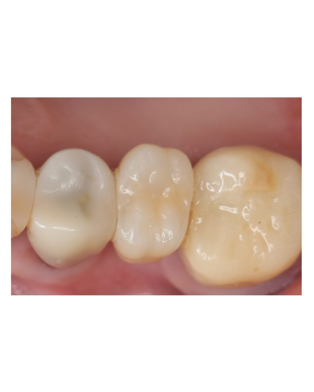 最終補綴装着後の状態