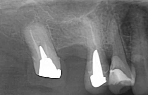 術前レントゲン写真
