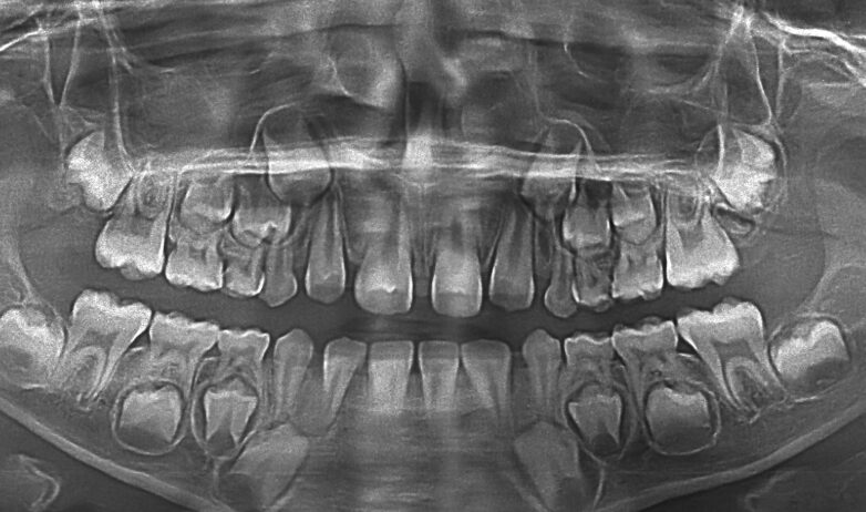 子供と大人の歯の形成イメージ