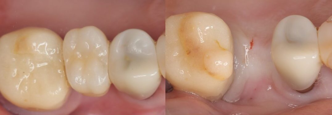 インプラント治療の術前後比較