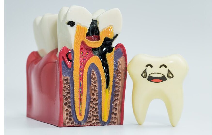 大人のむし歯のチェックポイント(亀岡市の歯医者)