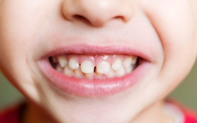 乳歯のすき間(すきっ歯)と永久歯の生え替わりイメージ|亀岡市はやかわ歯科小児矯正歯科