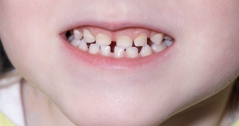 噛み合わせが逆の場合など、問題となる可能性が高い歯並びのイメージ|亀岡市小児矯正