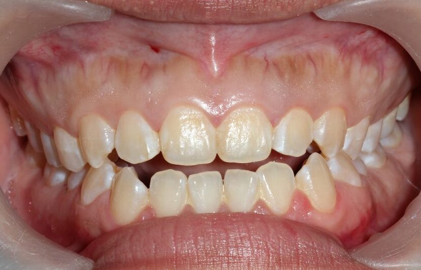 開咬（前歯が閉じない噛み合わせ）と舌の位置の説明イメージ（亀岡市の小児矯正）