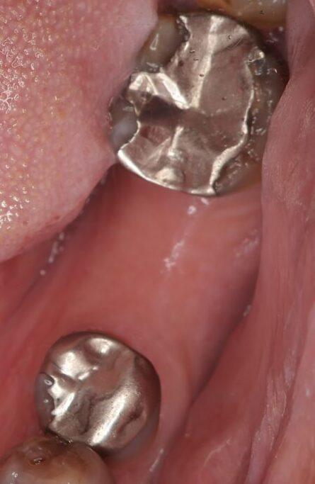 左下6番欠損の治療前口腔内写真