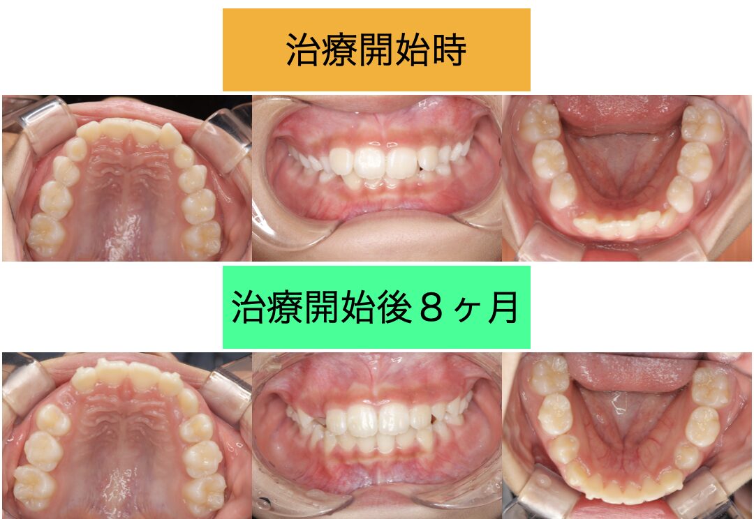 10歳の子どものマウスピース矯正：治療前後8ヶ月比較（叢生・過蓋咬合）｜亀岡市・南丹市