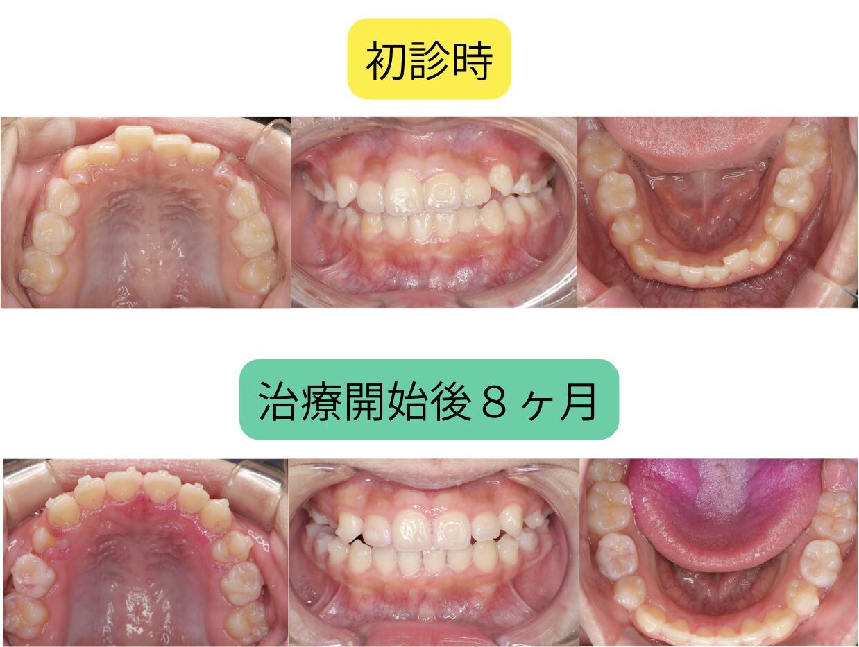 12歳の子どものマウスピース矯正：治療前後8ヶ月比較｜亀岡市・南丹市