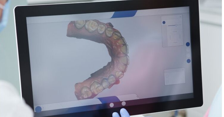 マウスピース矯正のスキャンデータと治療計画のイメージ